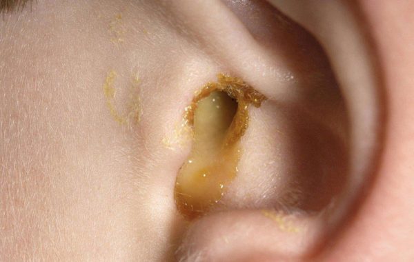 Viêm tai giữa là trạng thái tổn thương và viêm nhiễm xuất hiện trong tai giữa do tác nhân chính là vi khuẩn, virus gây nên