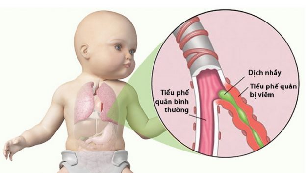 Viêm tiểu phế quản là căn bệnh thường gặp ở trẻ 3 tháng tuổi