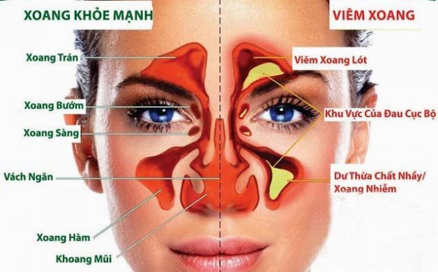 Viêm xoang mũi