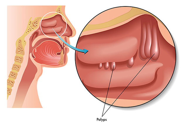Polyp mũi hay u mũi đều làm cản trở hoạt động của các lỗ xoang, làm tăng nguy cơ tắc nghẽn dịch hô hấp;