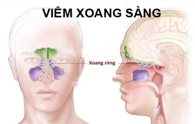 điều trị viêm xoang sàng