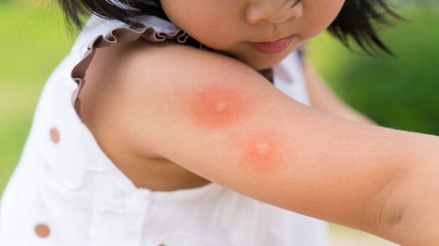 Bệnh sốt xuất huyết ở trẻ trải qua 3 giai đoạn