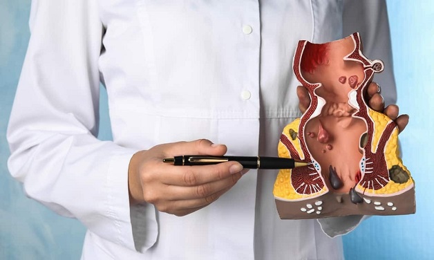 Bệnh trĩ nội và cách điều trị