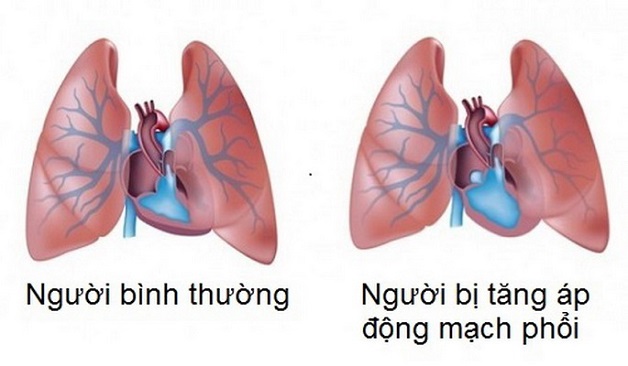 biến chứng tăng áp phổi ở bệnh nhân hẹp van tim 2 lá