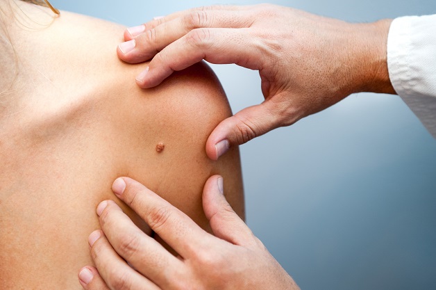 Dấu hiệu cảnh báo ung thư da ác tính