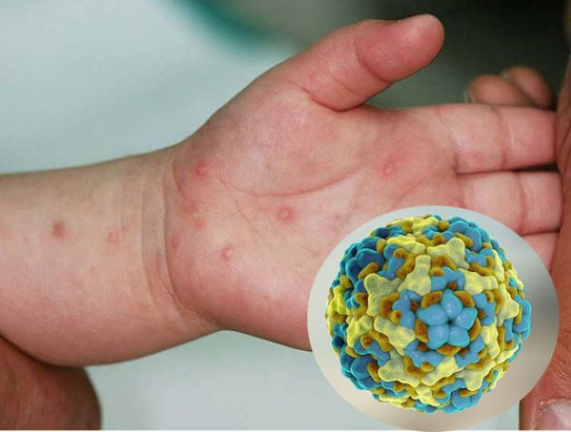 Thủ phạm gây ra bệnh chân tay miệng chủ yếu là do nhóm virus đường ruột có tên là: virus Coxsackievirus A16 và Enterovirus 71.