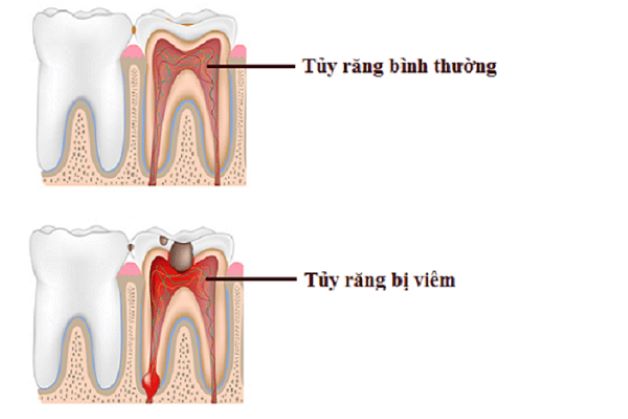 Viêm tủy răng là hiện tượng viêm nhiễm xảy ra ở tủy cùng các mô bao quanh chân răng.