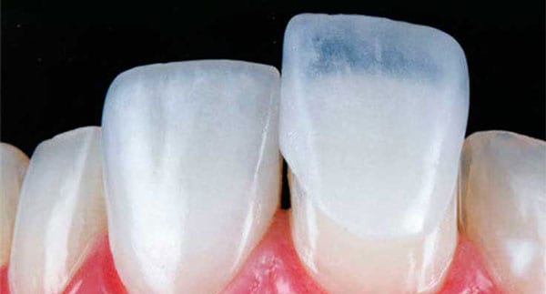 Dán sứ veneer sử dụng mặt sứ veneer có độ dày khoảng 0.3 - 0.5mm, có màu sắc tự nhiên như răng thật và gắn lên bề mặt răng