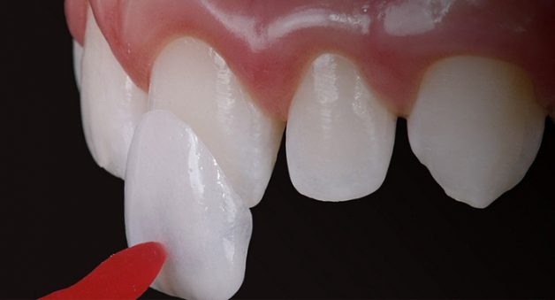 Dán veneer răng