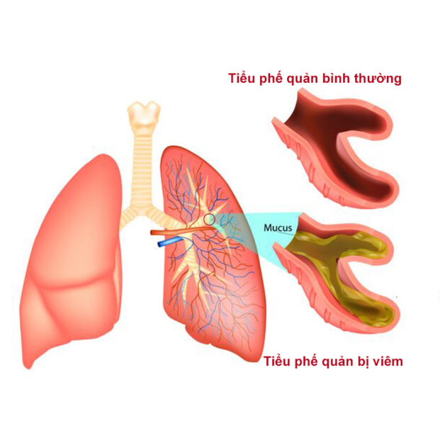 Viêm tiểu phế quản là bệnh lý nhiễm trùng tiểu phế quản