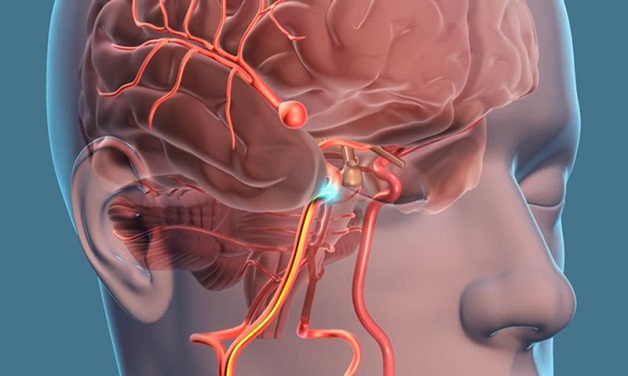 Đột quỵ chảy máu não do túi phình vỡ ra