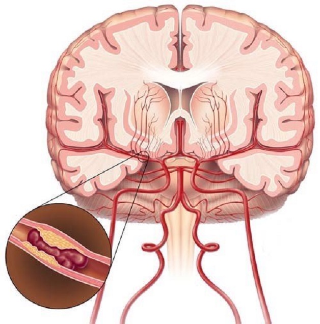 đột quỵ nhồi máu não