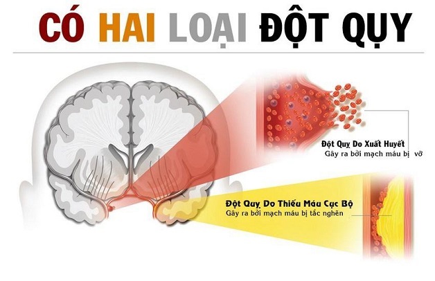 đột quỵ và tai biến mạch máu não là một bệnh