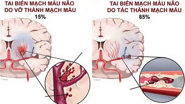 đột quỵ xuất huyết não ít gặp nhưng rất nguy hiểm