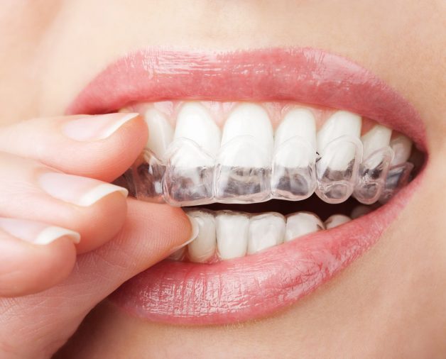 Cuối cùng, khách hàng sẽ dùng hàm duy trì để răng ổn định và không chạy lại về vị trí cũ