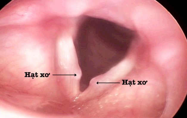 Xơ dây thanh là tình trạng dây thanh quản bị tổn thương do các hạt xơ mọc cả 2 bên dây thanh