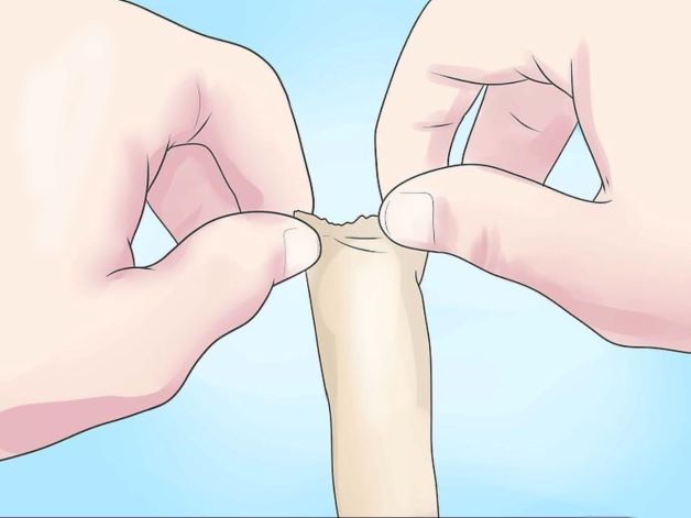 Cách tuột bao quy đầu tại nhà như thế nào cho đúng cách, an toàn, tránh nguy cơ lây nhiễm là mối quan tâm của nhiều cánh mày râu khi bị bệnh hẹp bao quy đầu.