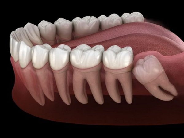 Với thắc mắc khi nào nên nhổ răng khôn, câu trả lời là răng khôn mọc lệch, mọc ngầm thì hầu như đều cần phải nhổ bỏ