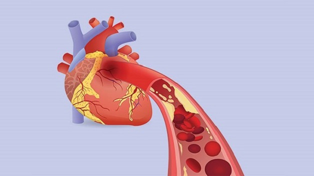 Nguyên nhân gây nhồi máu cơ tim