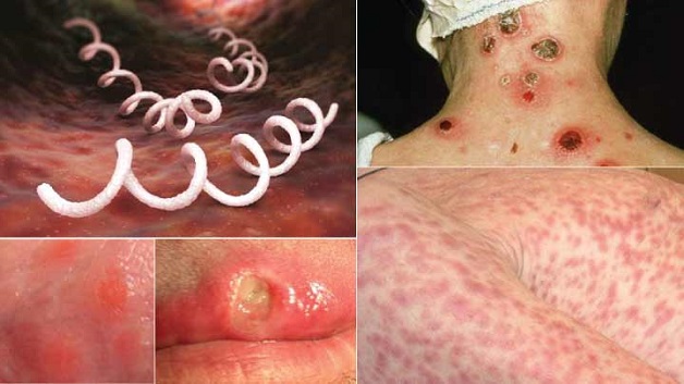nguyên nhân gây viêm dây thần kinh số 8