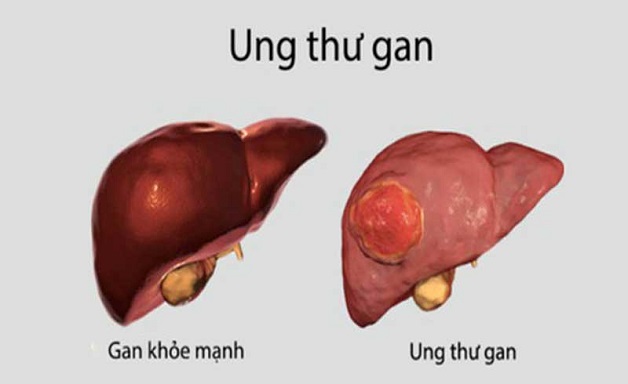 Dấu hiệu ung thư gan qua các giai đoạn phát triển