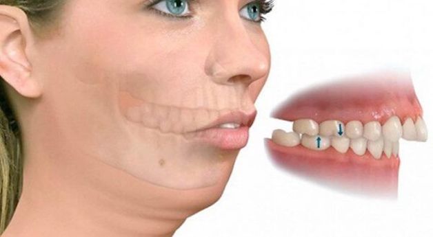 Ở những trường hợp hô nặng thì thường được chỉ định nhổ 4 răng số 4 để cải thiện tính thẩm mỹ