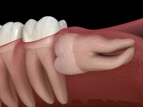 Răng mọc ngầm là răng nằm sâu bên trong xương hàm hoặc ngay dưới nướu