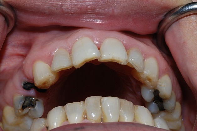 Nhổ răng sâu thường được chỉ định trong trường hợp răng sâu không thể điều trị bảo nhằm tránh gây tổn thương các răng xung quanh
