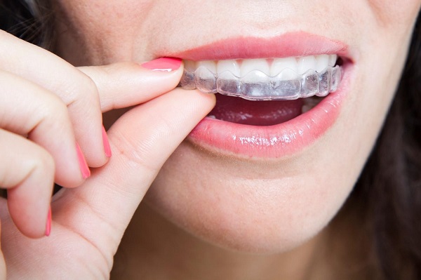 Niềng răng bao lâu được tháo còn phụ thuộc vào nhiều yếu tố