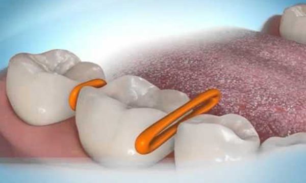 Với thắc mắc niềng răng có đau không, ở giai đoạn đặt thun tách kẽ, chúng ta có thể cảm thấy hơi đau, nhức do thun sẽ tách răng tạo thành các khoảng trống để dễ di chuyển