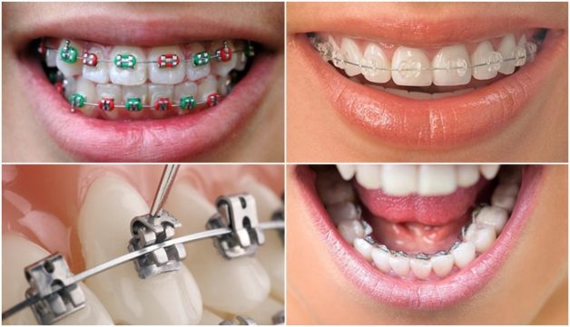 Niềng răng được đánh giá là phương pháp thẩm mỹ an toàn và có hiệu quả lâu dài