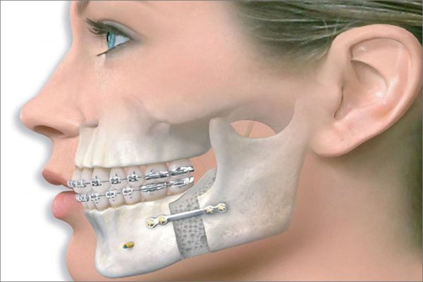 Răng hô hay còn gọi răng vẩu là một dạng sai lệch khớp cắn gây ảnh hưởng đến tương quan giữa hàm trên và hàm dưới.