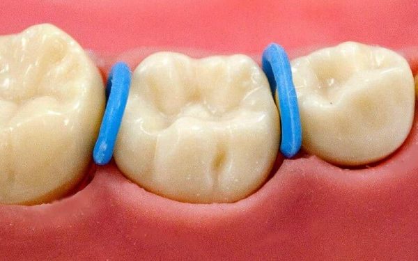 Với thắc mắc niềng răng hô có đau không, niềng răng có thể hơi đau nhức ở một số giai đoạn, ví dụ như đặt thun tách kẽ