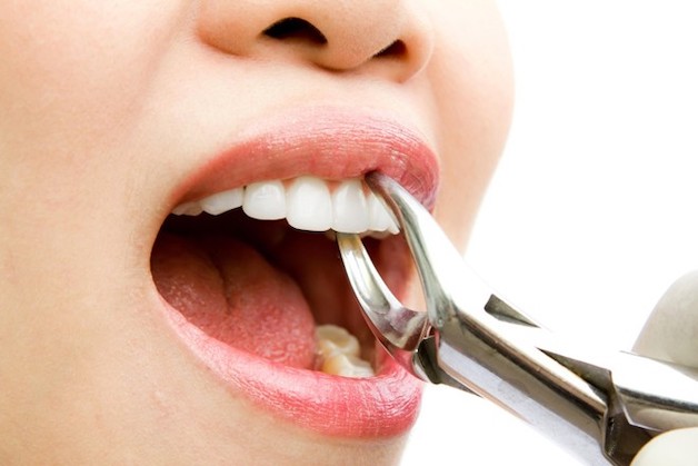 Nhổ răng là chỉ định phổ biến trong chỉnh nha giúp răng có khoảng trống để di chuyển về vị trí mong muốn