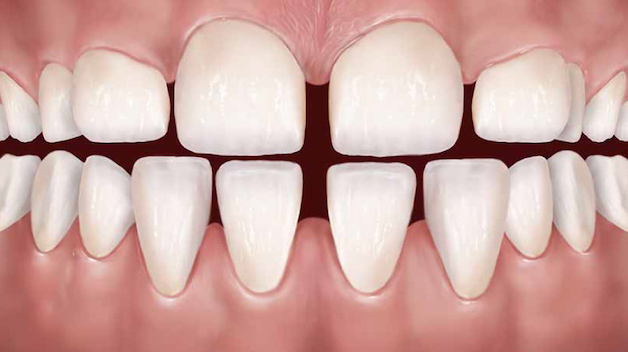 Răng thưa là một trong những trường hợp niềng răng không nhổ điển hình