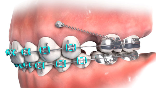 Nhổ răng là chỉ định bắt buộc để tạo khoảng trống, giúp răng di chuyển thuận lợi