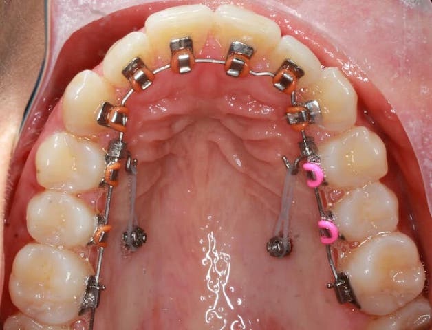 Niềng răng mắc cài mặt trong sử dụng mắc cài và dây cung được gắn vào mặt trong của răng, nhờ đó đảm bảo được tính thẩm mỹ cũng như vẫn giữ được độ hiệu quả của phương pháp niềng răng mắc cài kim loại truyền thống.