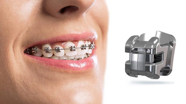 Niềng răng mắc cài tự động