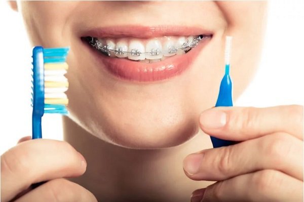 Niềng răng mất bao nhiêu thời gian phụ thuộc vào nhiều yếu tố, ví dụ như cách chăm sóc răng