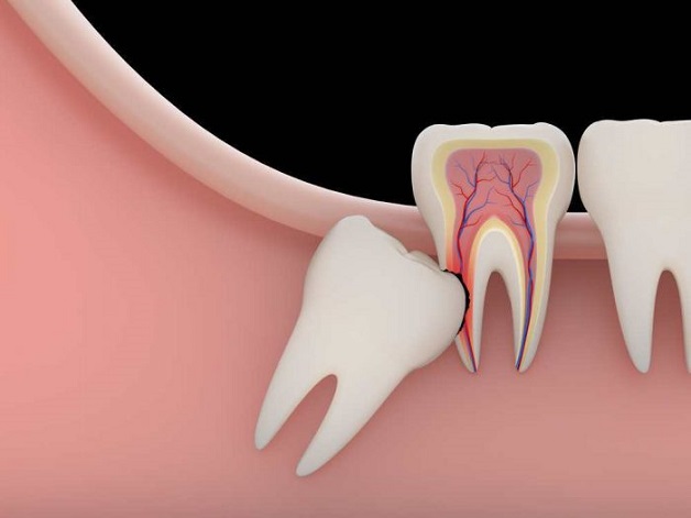 Phẫu thuật nhổ răng khôn thường được chỉ định trong trường hàm răng khôn mọc lệch, mọc ngầm gây ảnh hưởng đến răng số 7 và các răng kế cận khác