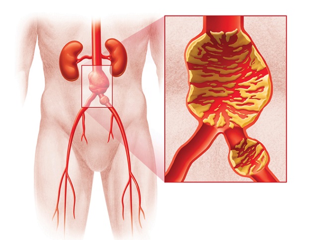 xơ vữa mạch chủ bụng