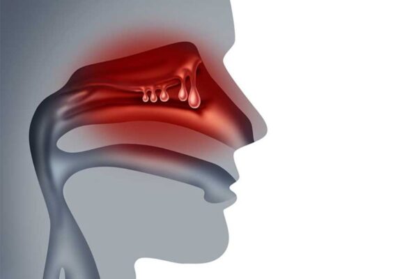 Polyp mũi xoang là hậu quả của phản ứng viêm gây ra bởi viêm nhiễm vi khuẩn hoặc virus