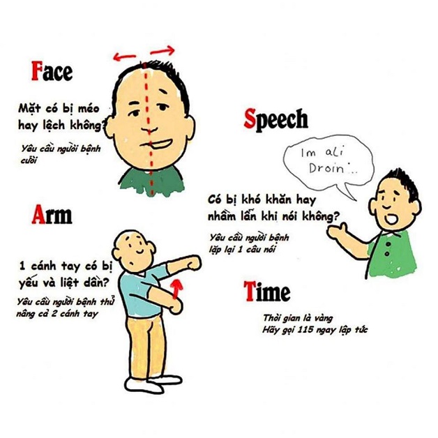 F.A.S.T là triệu chứng nhận biết tai biến mạch máu não điển hình.