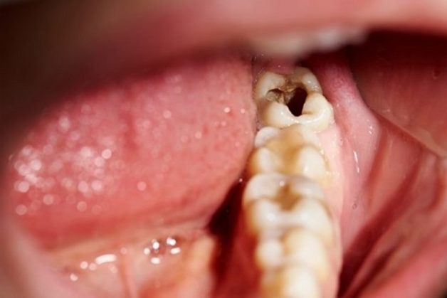 Răng số 8 bị sâu vỡ