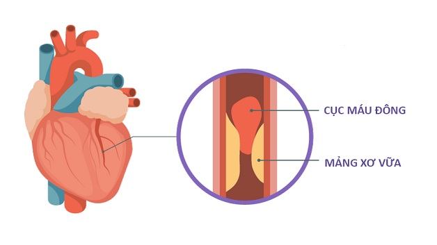 vữa xơ động mạch nguy hiểm như thế nào?
