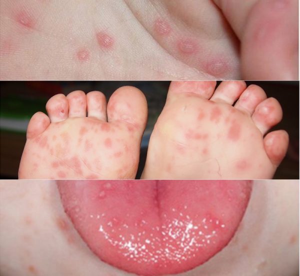 Tay chân miệng là bệnh truyền nhiễm, lây truyền chủ yếu qua đường tiêu hóa.