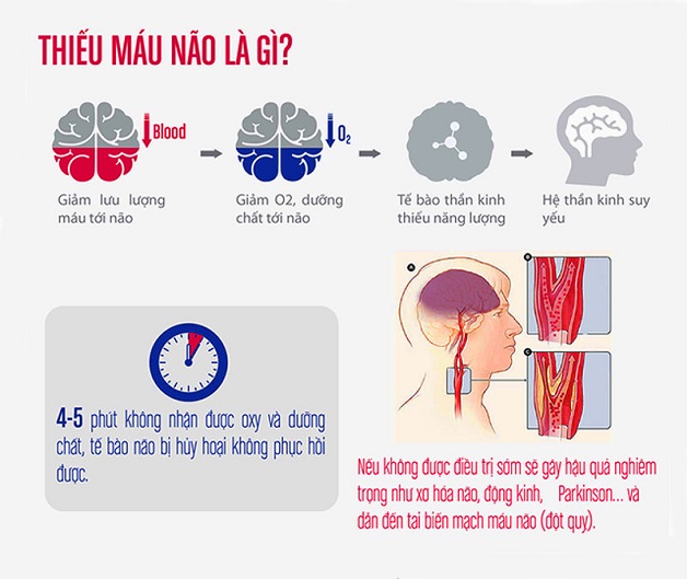 thiếu máu não có triệu chứng gì?