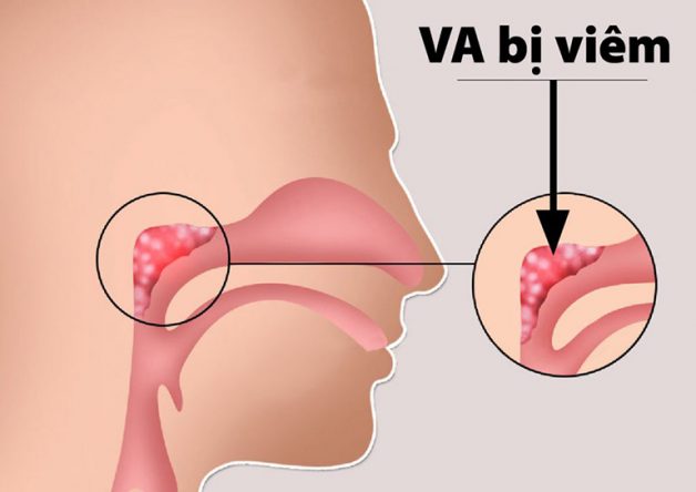 Viêm VA
