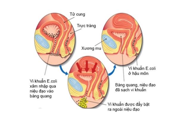 Có rất nhiều nguyên nhân gây viêm đường tiết niệu ở trẻ em.
