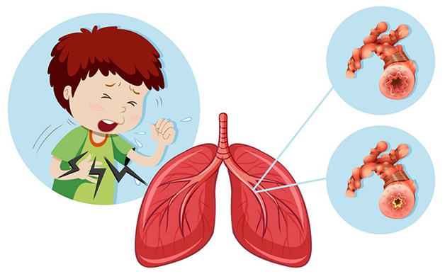 Viêm phế quản cấp là căn bệnh nhiều trẻ em gặp phải